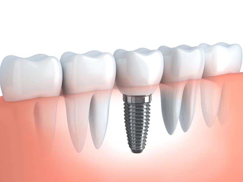 Dental Implants Hickory, NC 