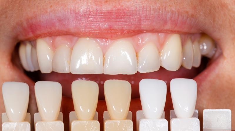 Veneers Hickory, NC 